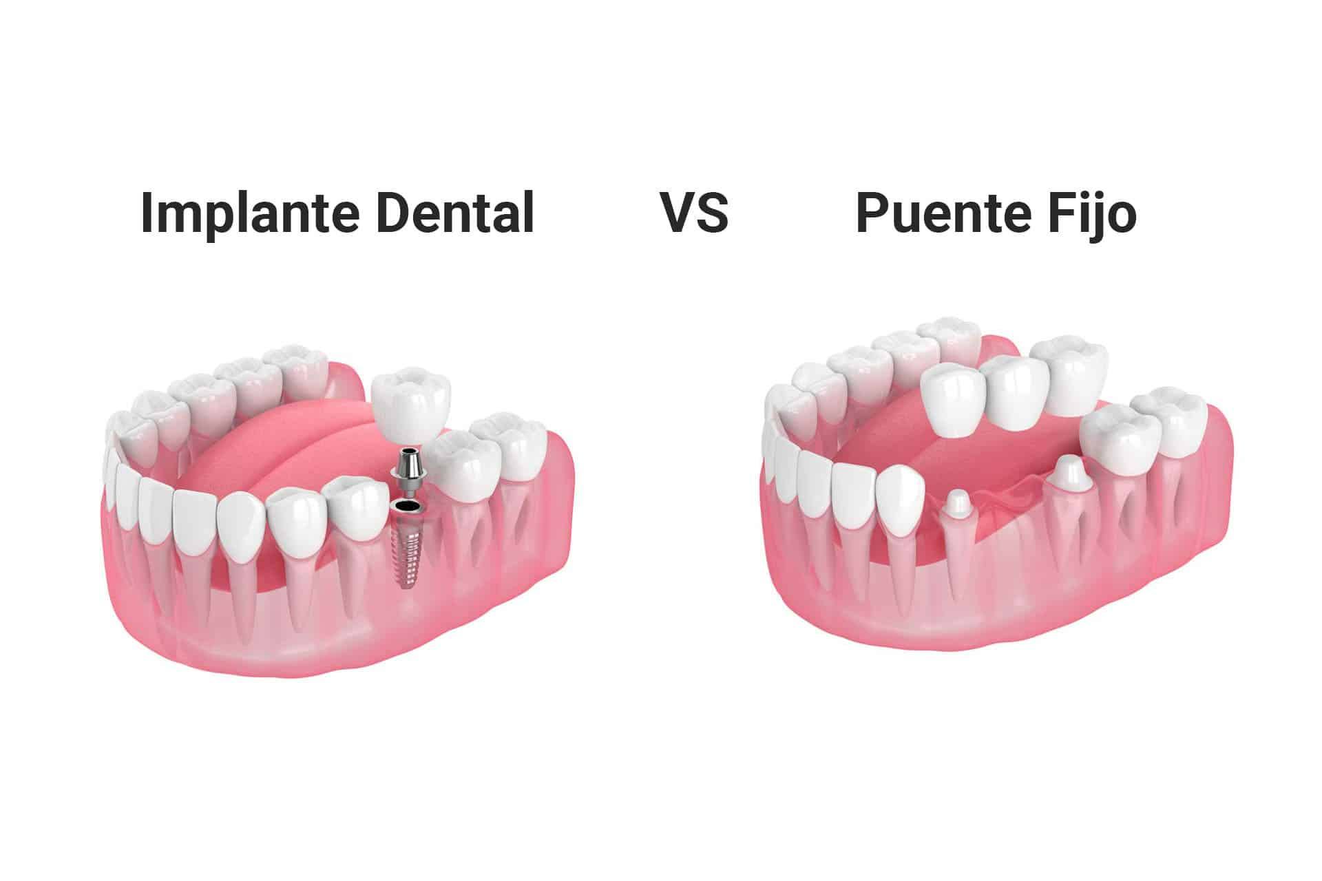 Implantes dentales vs. puentes: ¿Cuál es el método más duradero para reponer un diente?